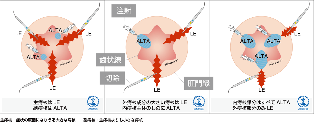 痔核結紮切除術とALTAの併用療法