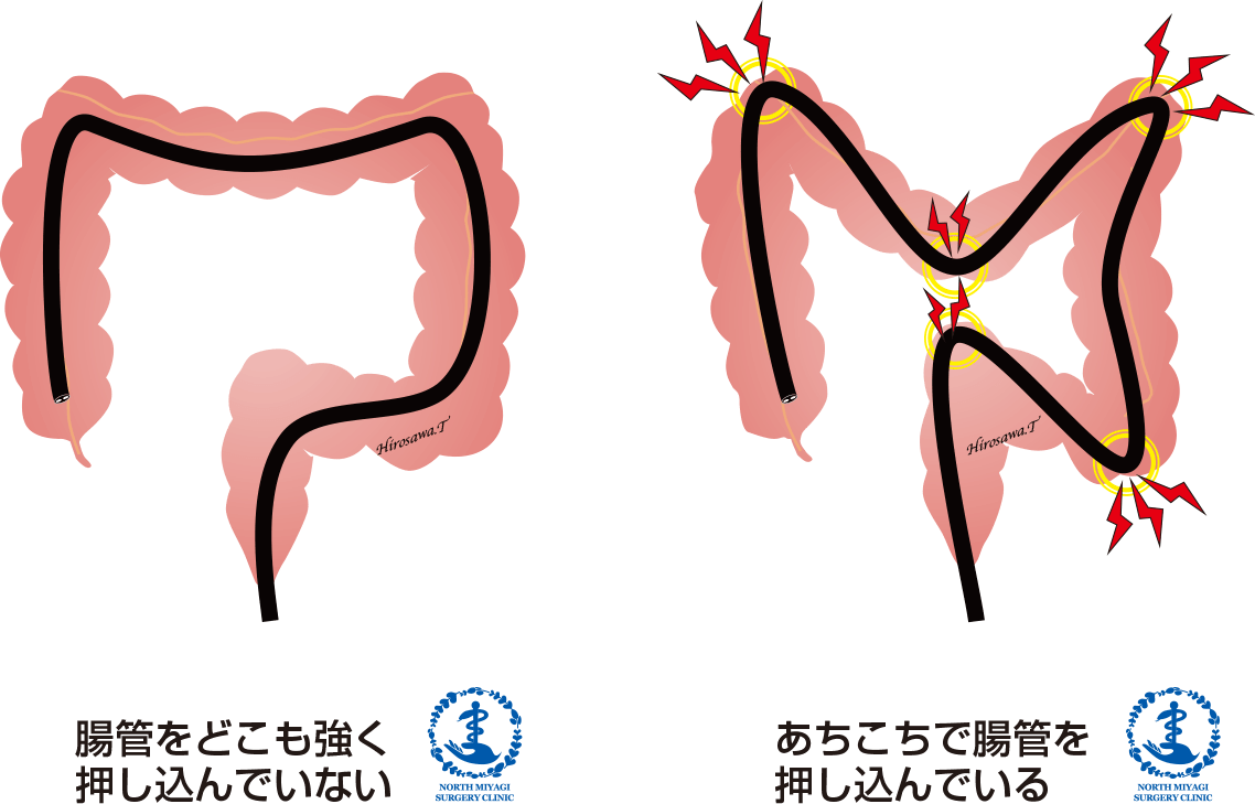 軸保持短縮法