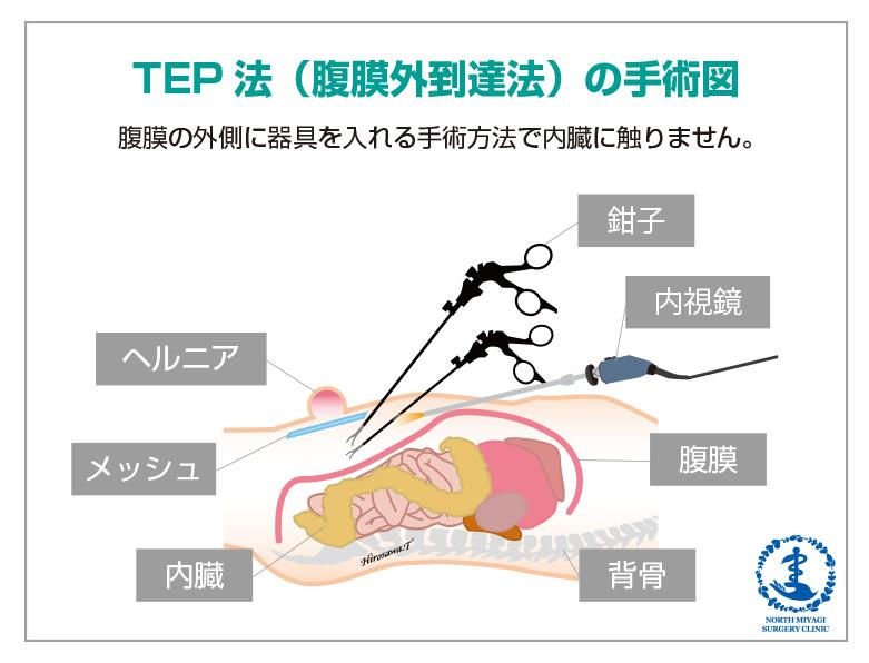 TEP法（腹膜外到達法）の手術図