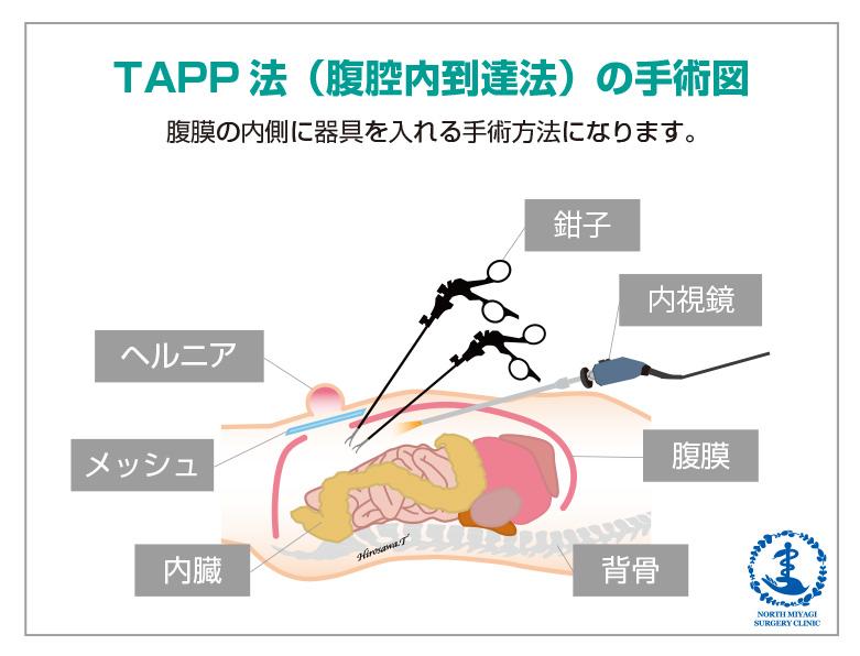 TAPP法（腹腔内到達法）の手術図